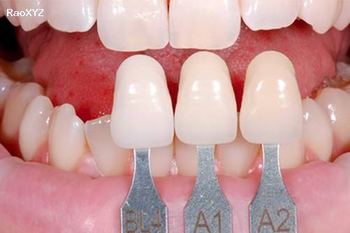 Tại sao bọc răng sứ cần đến nha khoa uy tín