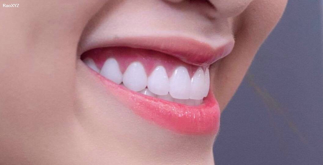 Có nên bọc răng sứ thẩm mỹ nguyên hàm hay không