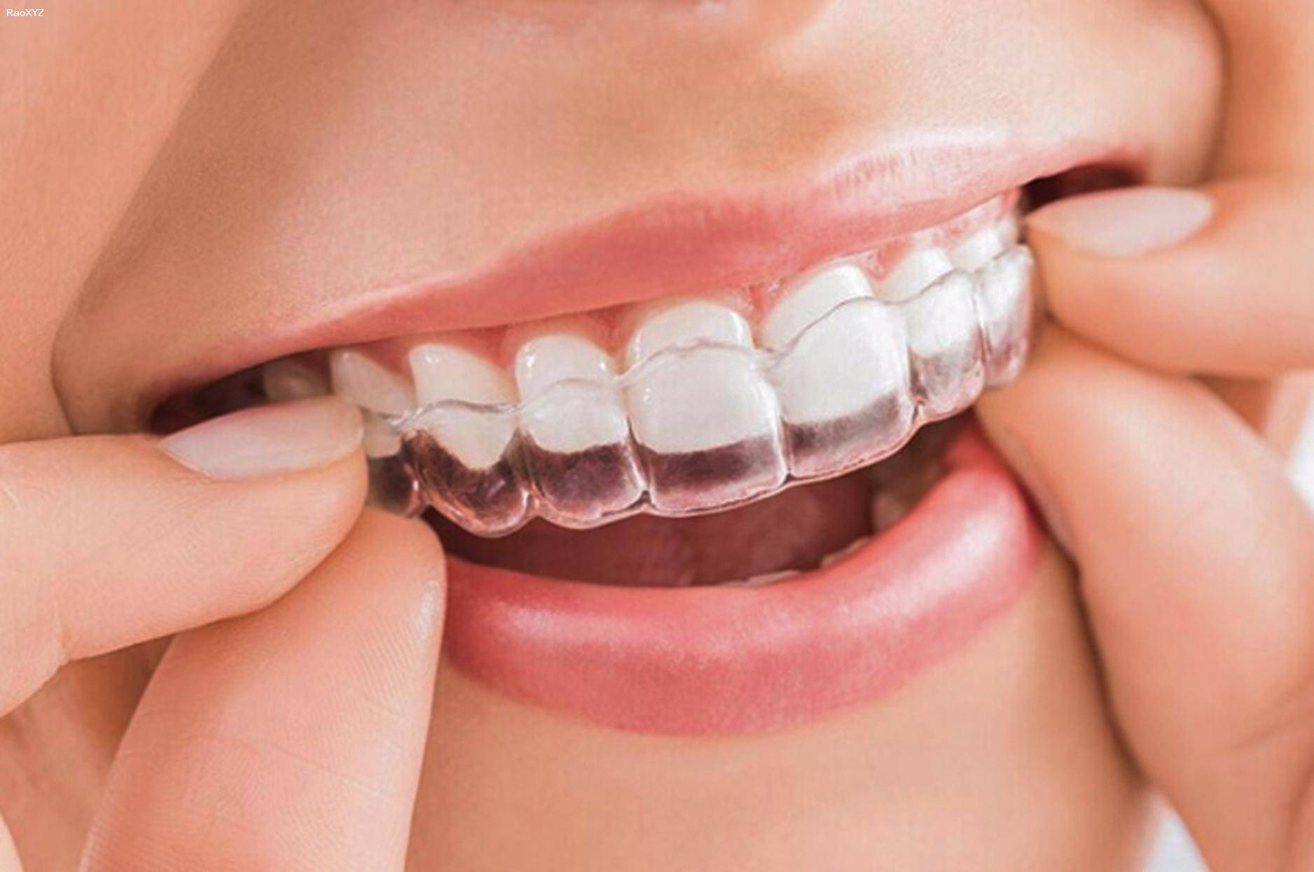 Niềng răng là gì? Bao nhiêu tuổi bạn niềng răng là tốt nhất