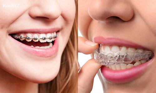 Tại sao cần niềng răng? Niềng răng có công dụng gì?